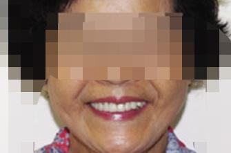 延安小白兔口腔医院怎么样？做牙齿种植项目好不好？医院介绍附案例和价格表！(图3)