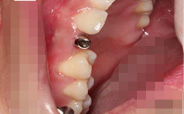 延安小白兔口腔医院怎么样？能做种植牙吗？医院介绍附案例分享和价格表！(图2)