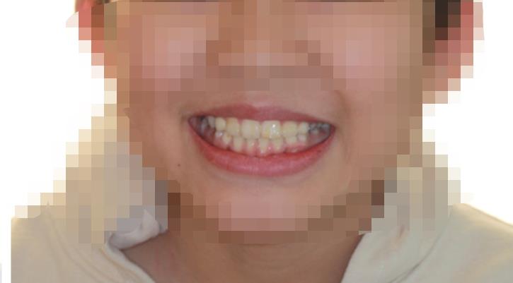 宁波口腔医院和海曙口腔医院哪个好？两家医院介绍附牙齿矫正案例和价格表！_2(图3)