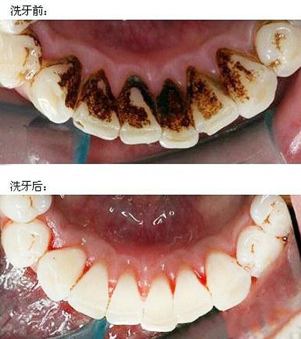 怀孕口腔溃疡怎么办;怀孕口腔溃疡怎么办较快较有效的方法