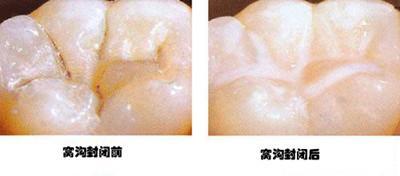 牙齿刷牙酸痛怎么办(牙齿刷牙酸痛怎么办吃什么药)(图2)