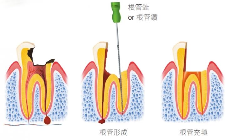 恒牙松动怎么办_新换的恒牙松动怎么办
