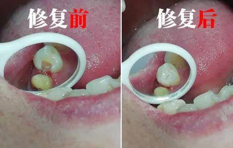 牙齿快掉了怎么弄下来，牙齿快掉了怎么弄下来不疼小孩