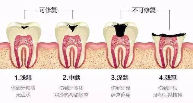 牙齿上有黑渍怎么去除、牙齿上有黑渍怎么去除后注意事项