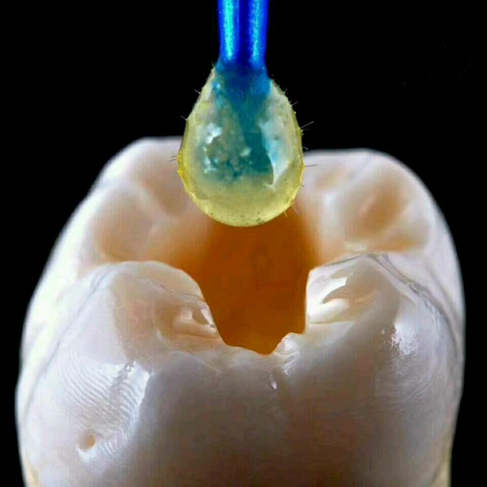 牙结石怎么自己去除，少量牙结石怎么自己去除