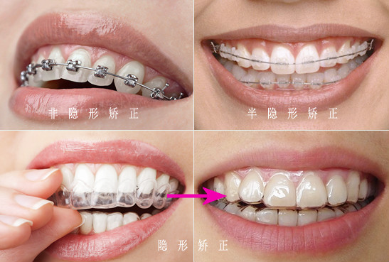 门牙歪斜怎么矫正_门牙歪斜怎么矫正速度快(图3)