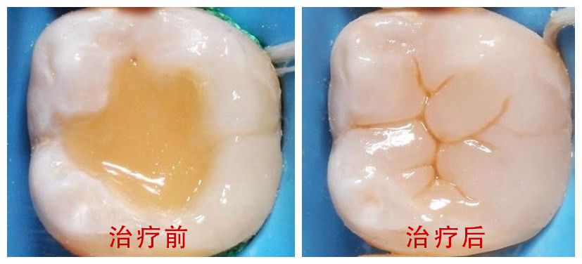 口腔白斑怎么治疗，口腔白斑怎么治疗较快(图3)