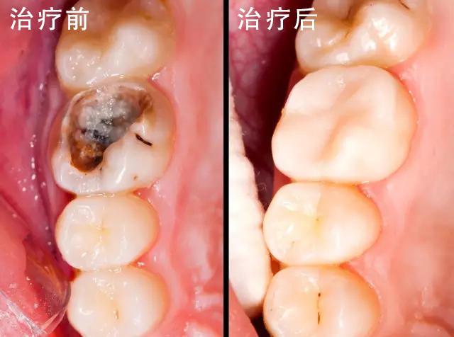 下巴后缩怎么办(下巴后缩怎么办？口腔支架)(图2)