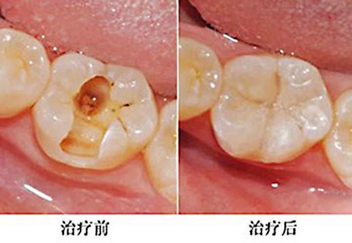 补牙后牙齿痛怎么办_补牙后牙齿痛怎么办吃什么药
