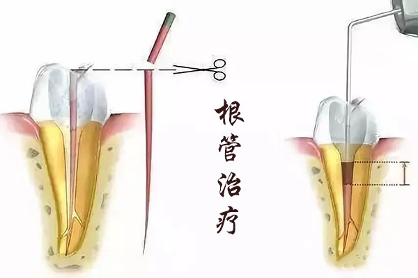六龄牙坏了怎么办、小孩六龄牙坏了怎么办