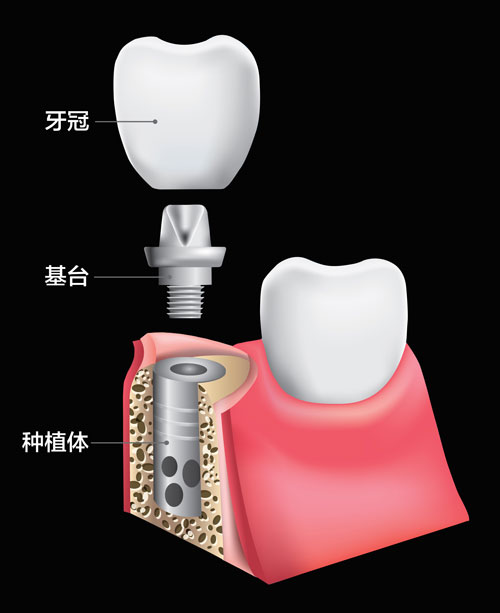 牙根在牙齿没了怎么办-牙根在牙齿没了怎么办图片(图2)