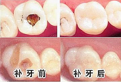 下颌后缩怎么矫正_下颌后缩怎么矫正青少年