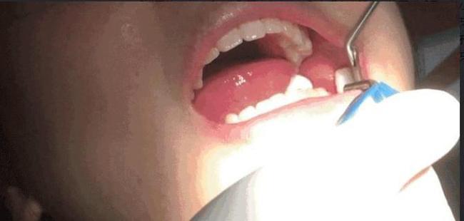 智齿怎么拔-横着的智齿怎么拔