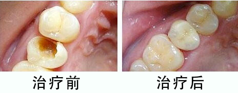 口腔白斑怎么治疗，口腔白斑怎么治疗较快(图2)