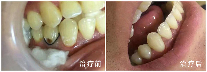 智齿痛怎么缓解(智齿疼怎么缓解疼痛)(图3)