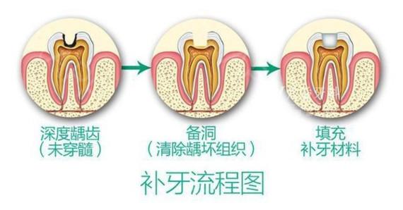 牙齿酸软怎么办—咬东西牙齿酸软怎么办