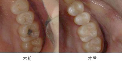 口腔白斑怎么治疗，口腔白斑怎么治疗较快
