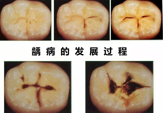 蛀牙怎么治疗_成人蛀牙怎么治疗