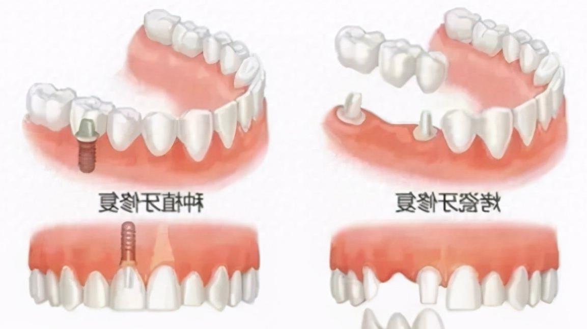 杭州亮贝美口腔医院种植牙服务解析：专业评价与价格指南(图2)