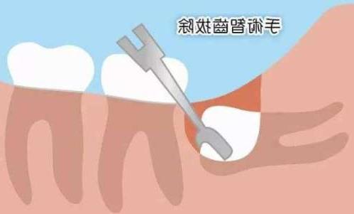 牙齿修复价格全解析：全瓷牙、烤瓷牙与种植牙的比较(图1)