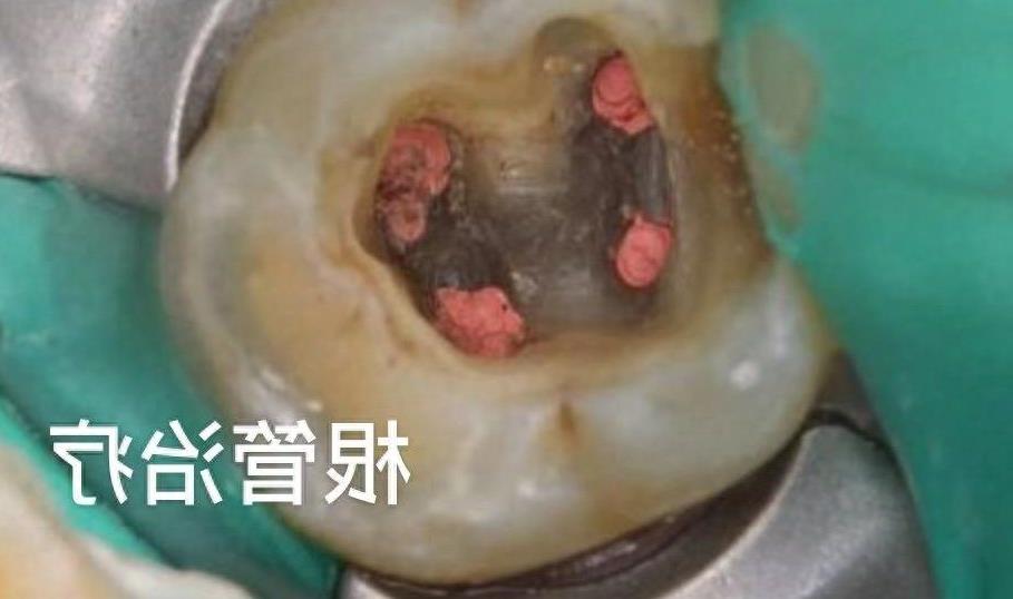 种植牙费用大揭秘：国产与进口品牌价格全解析(图1)